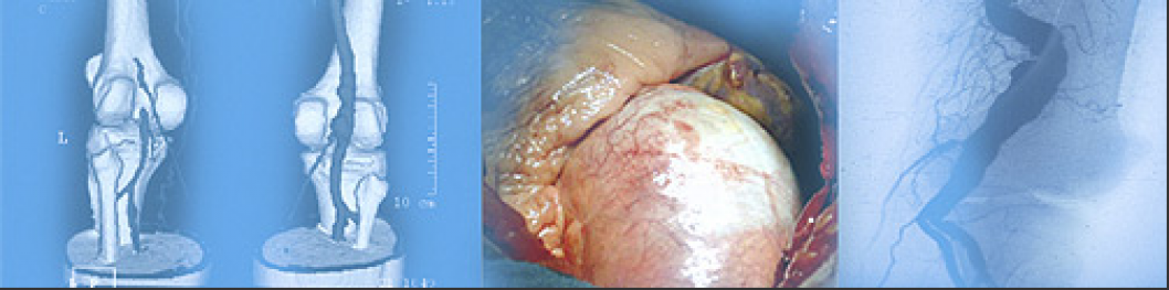 arteriopathie.png