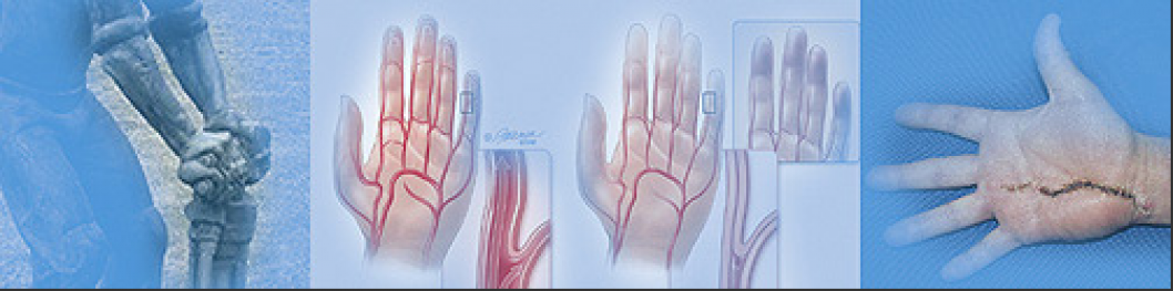 hammersyndrom_2.png