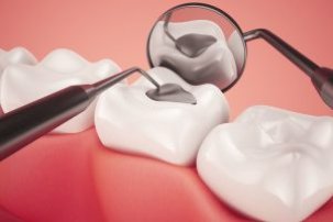 tooth filling
