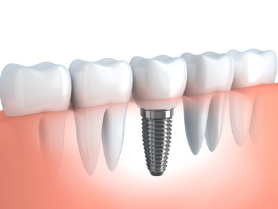 Implantate