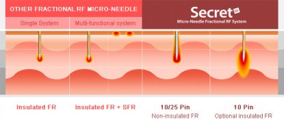 Microneedling Behandlungsmethode und Erfolg