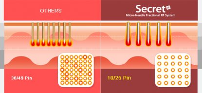 Microneedling Behandlungsmethode und Erfolg